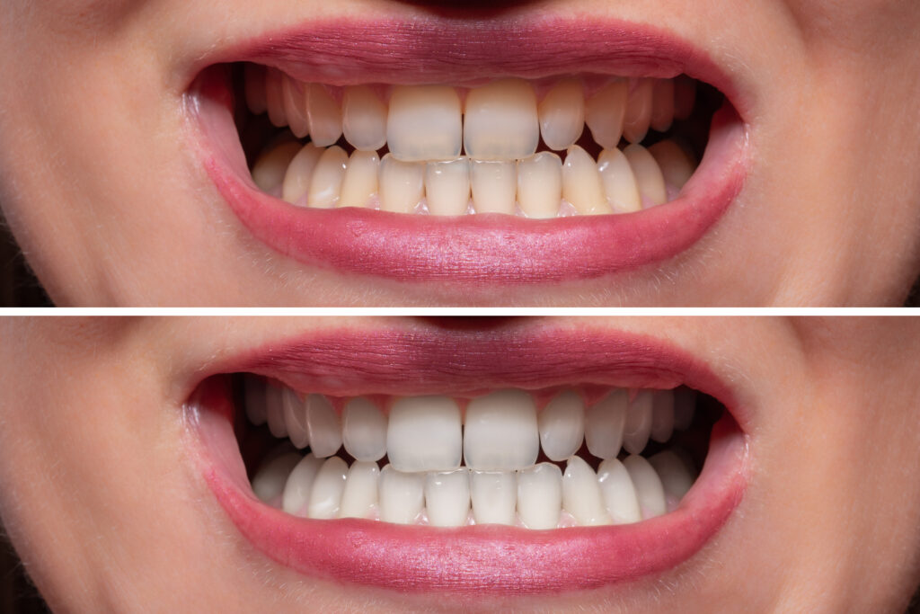 Teeth before and after whitening