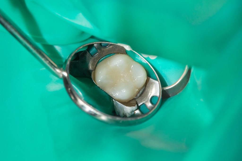 Tooth after aesthetic dental fillings