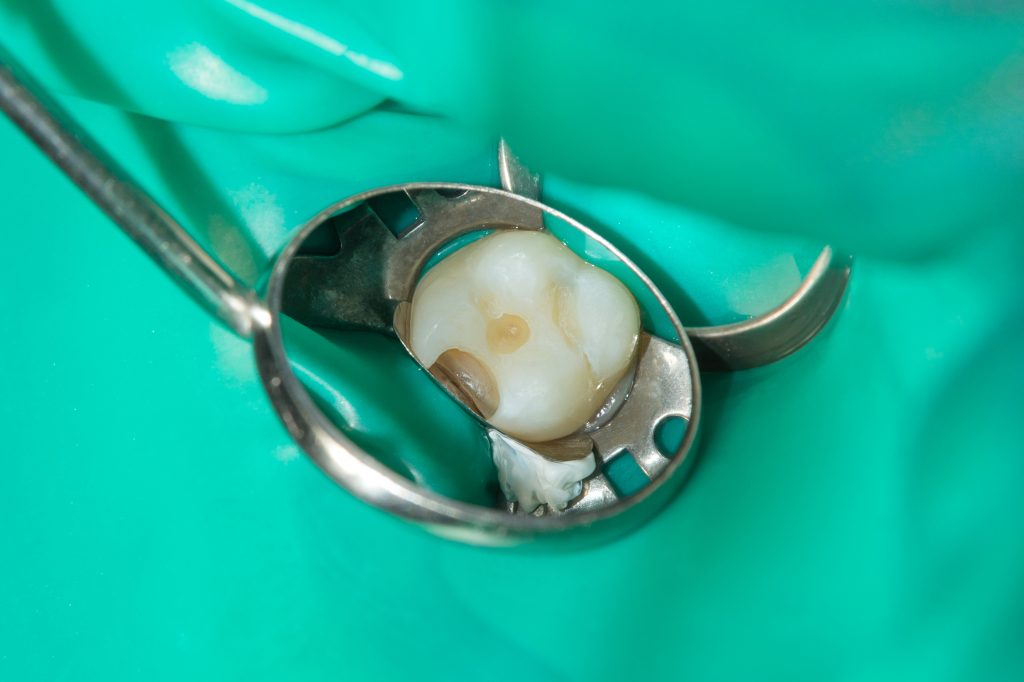 Cleaned cavities before aesthetic dental fillings