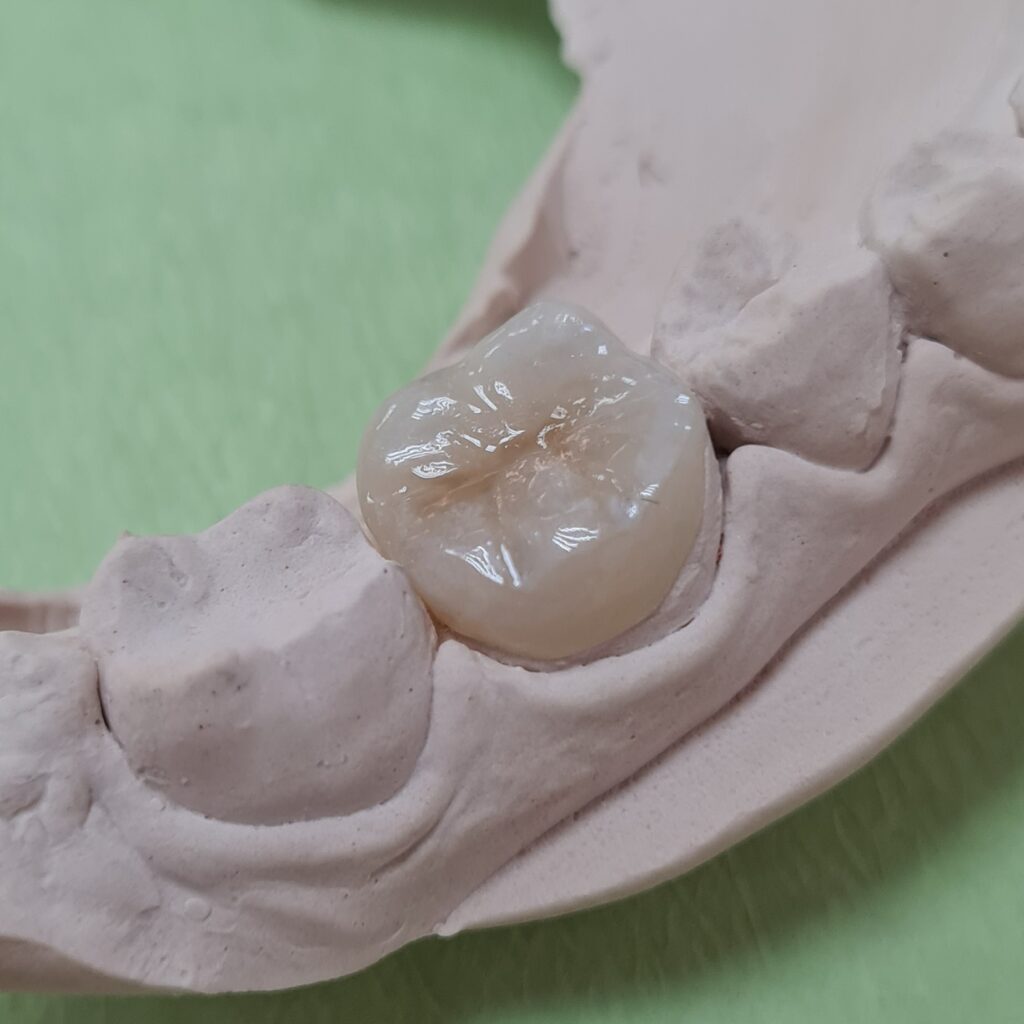 A custom overlay crafted at 360 Dental