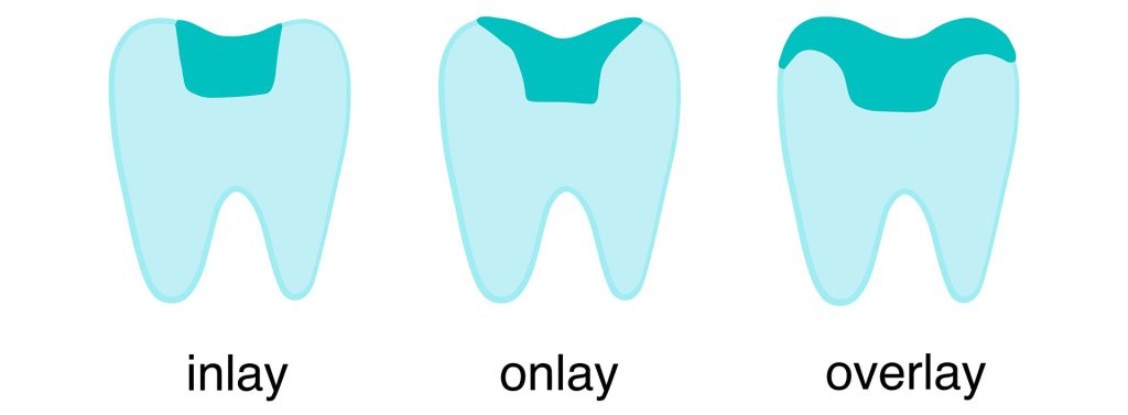 Inlay, onlay, overlay fogbetétek sematikus ábrázolása