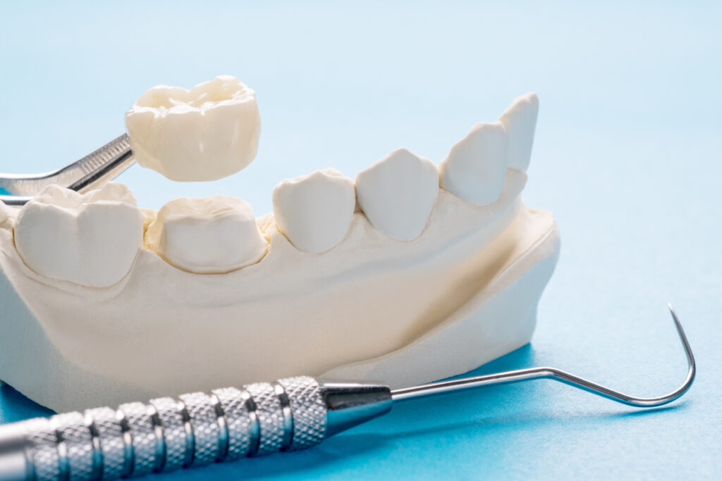 Zirconia crown as tooth replacement