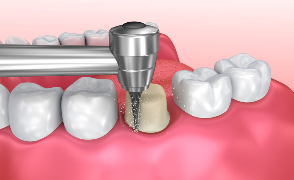 Preparing a tooth for a crown