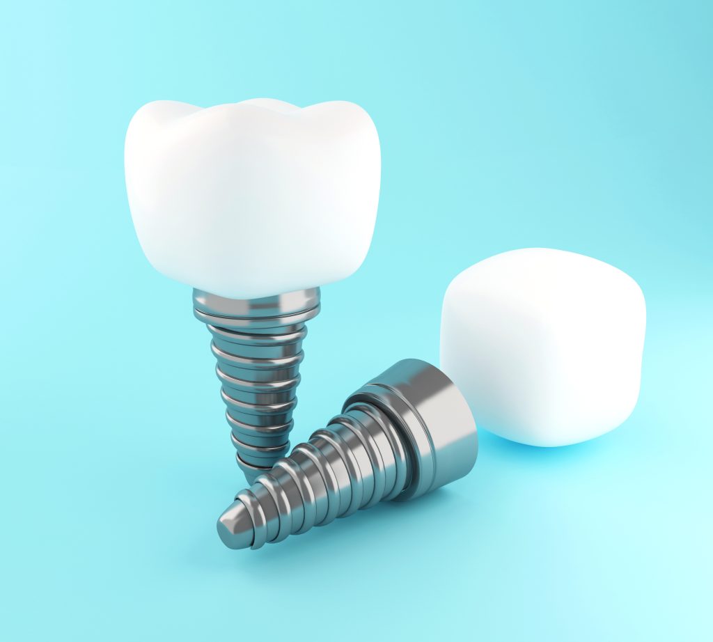 3D Dental implants with crowns