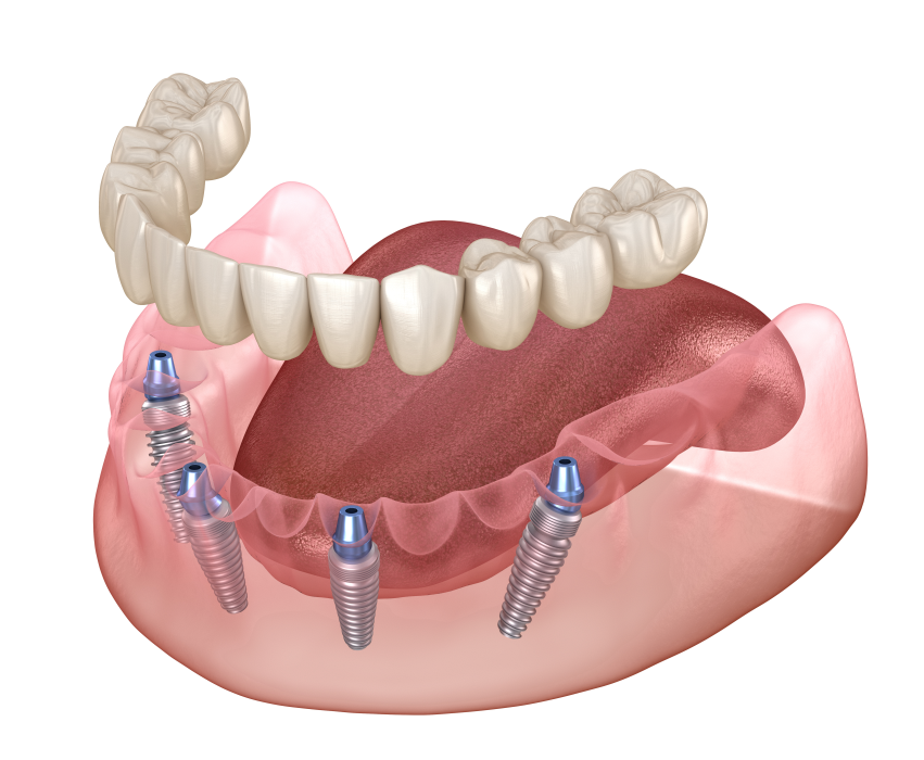 Denture fixed with 4 implants - All-on-4