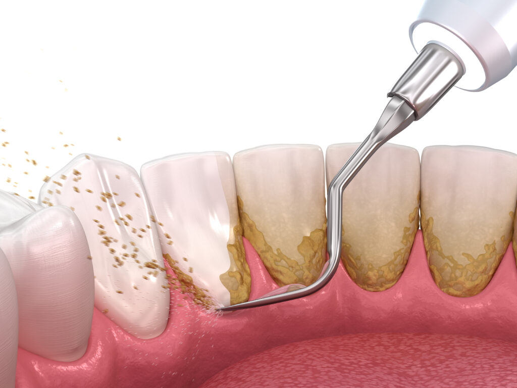 Ultrasonic tartar removal process