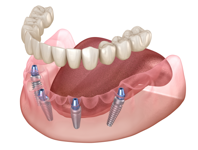 4 implantátummal rögzített fogpótlás - All-on-4